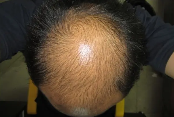 男性脱发怎么改善 怎么理解脱发