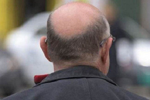男生脱发严重该怎么办 如何预防脱发